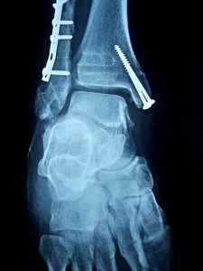 X-ray of broken ankle post reconstructive surgery